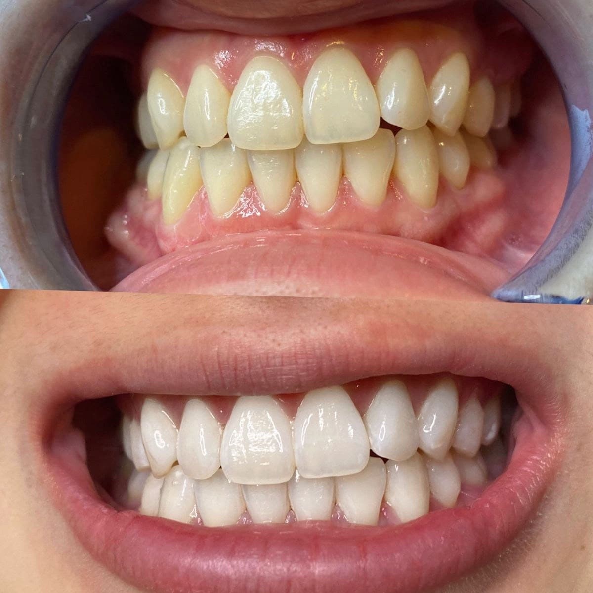 Teeth Whitening (Clinical Bleaching) — Clinical Dental Care at Dant काया Multispeciality Clinic, Patna