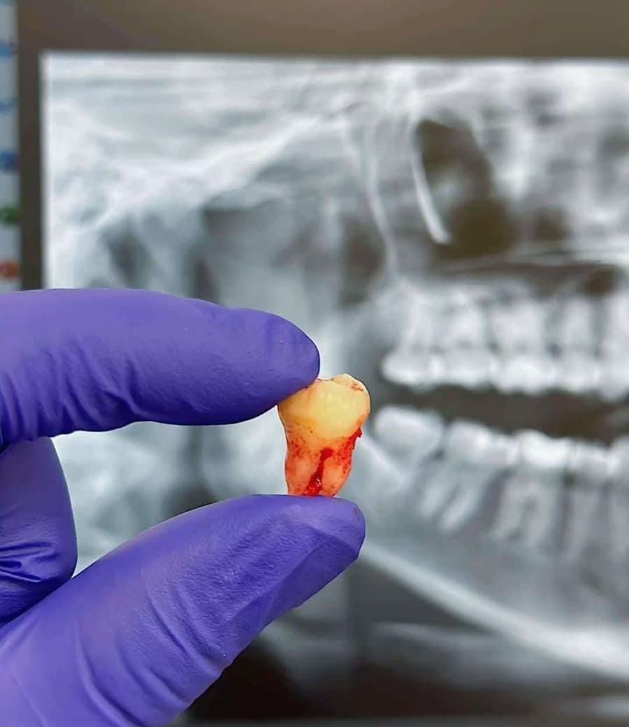 Third Molar Surgery & Disimpaction — Clinical Dental Care at Dant काया Multispeciality Clinic, Patna